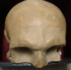 burns skull